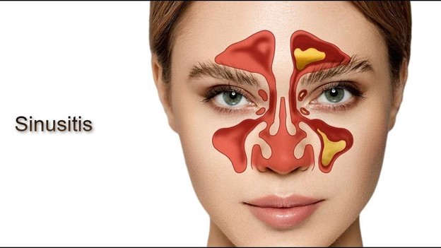 Is your facial pain actually sinus-related