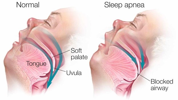 Why does snoring get worse over time